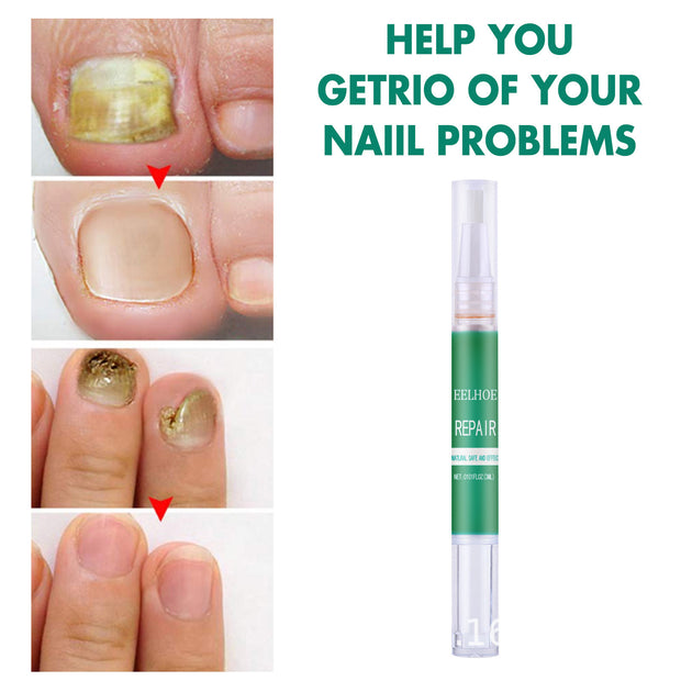 Onychomycosis Nutrition Pen Repair Yellow Nails